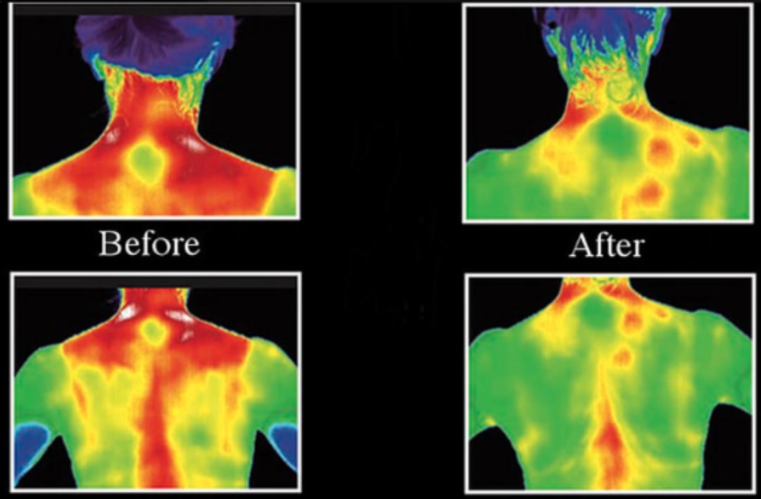 Infrared image of before and after Equiscope treatment for pain support.